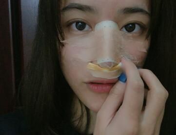 上海九院整形科隆鼻案例术后恢复过程反馈图分享自然还没有留疤