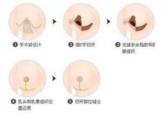 早期的乳房缩小整形手术是怎样的呢？