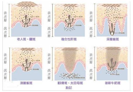 颧颊部对称黄褐斑调节价格~抄底大放送~