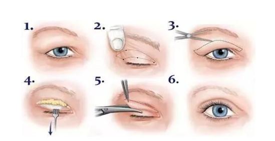 全切双眼皮术后3个月可以做修复手术了吗？