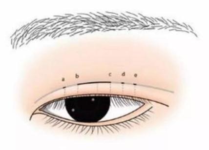 全切双眼皮术后3个月可以做修复手术了吗？