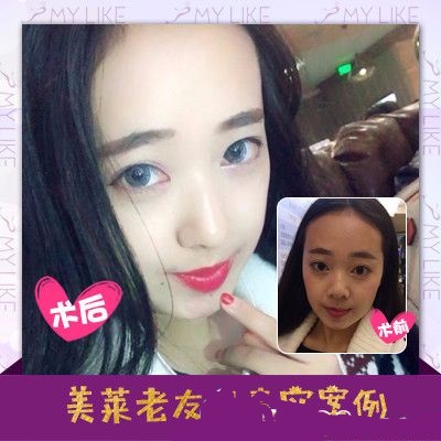 深圳美莱梁晓健做的全脸自体脂肪填充案例