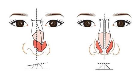 鼻梁骨矫正手术调节的基本原理及整体，看了以后很动心