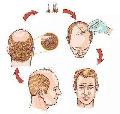 头发种植还有这一些副作用绝大部分医生不可能对你说