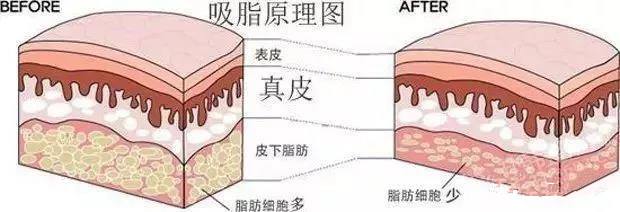 大腿吸脂手术需要多久？全部手术调节流程方法步骤