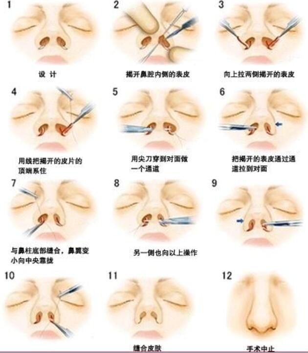 鼻延长手术图解图片