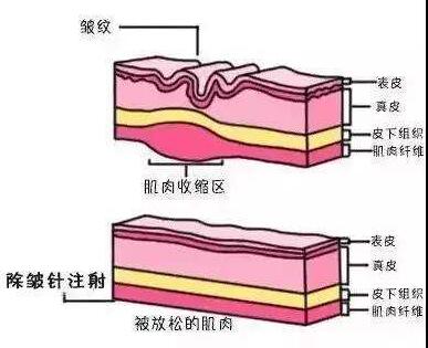 去鱼尾纹要多少钱？去鱼尾纹的具体方法有什么