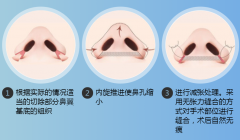 鼻翼收缩手术的操作步骤及术后护理事项