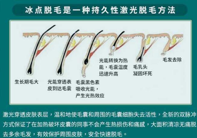 腋下长期性脱毛多少钱？医疗美容大咖来为你讲一讲