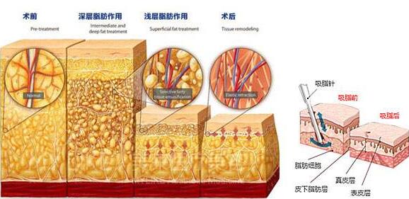 环形抽脂有什么危害吗？告别“五花肉”还是抽脂好