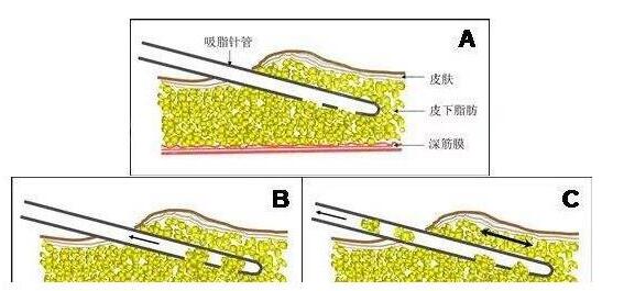 腰部吸脂减肥手术恢复期注意事项