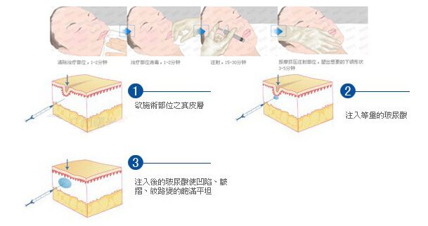 艾莉薇玻尿酸适合打哪里？这个部位用它果zui好！