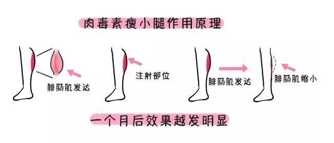 吸脂瘦腿的方法图片