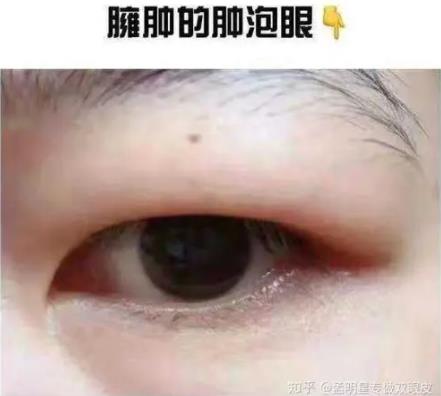 眼皮抽脂后护理的注意事项？眼皮抽脂适合哪些人？