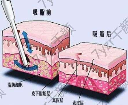 什么是大腿环吸