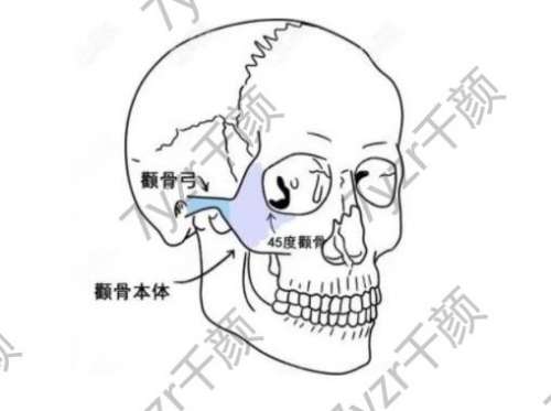 颧骨内推手术适应症解析